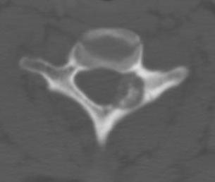 Osteoblastoma Bone Window